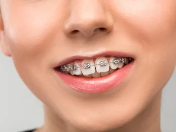 Orthodontic care at Dental Specialists Turramurra