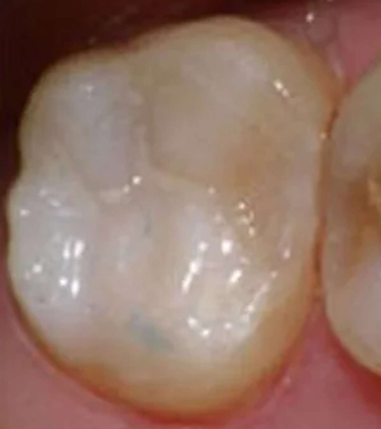 Composite resins