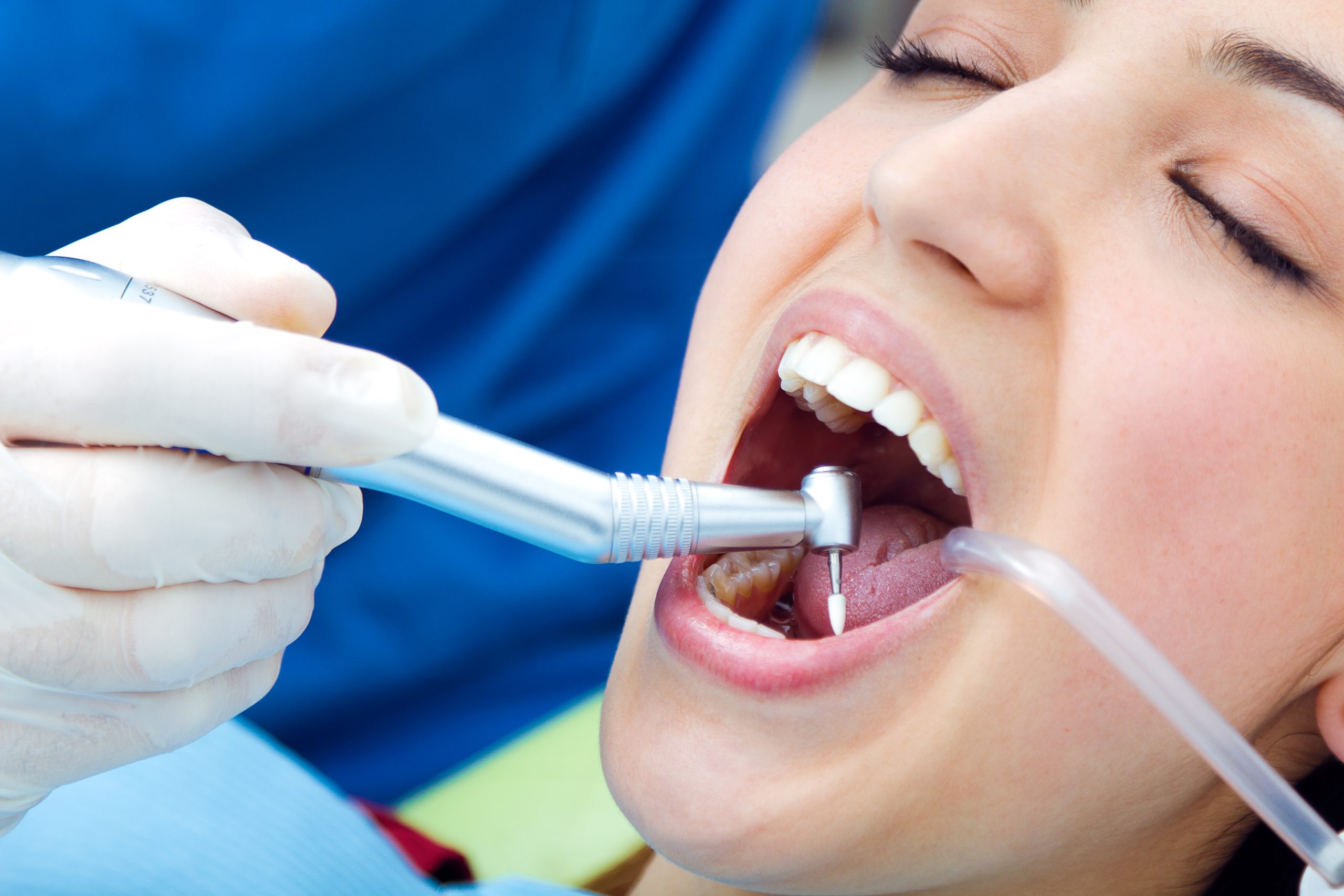 Tooth Erosion Acid Wear Treatment in Turramurra