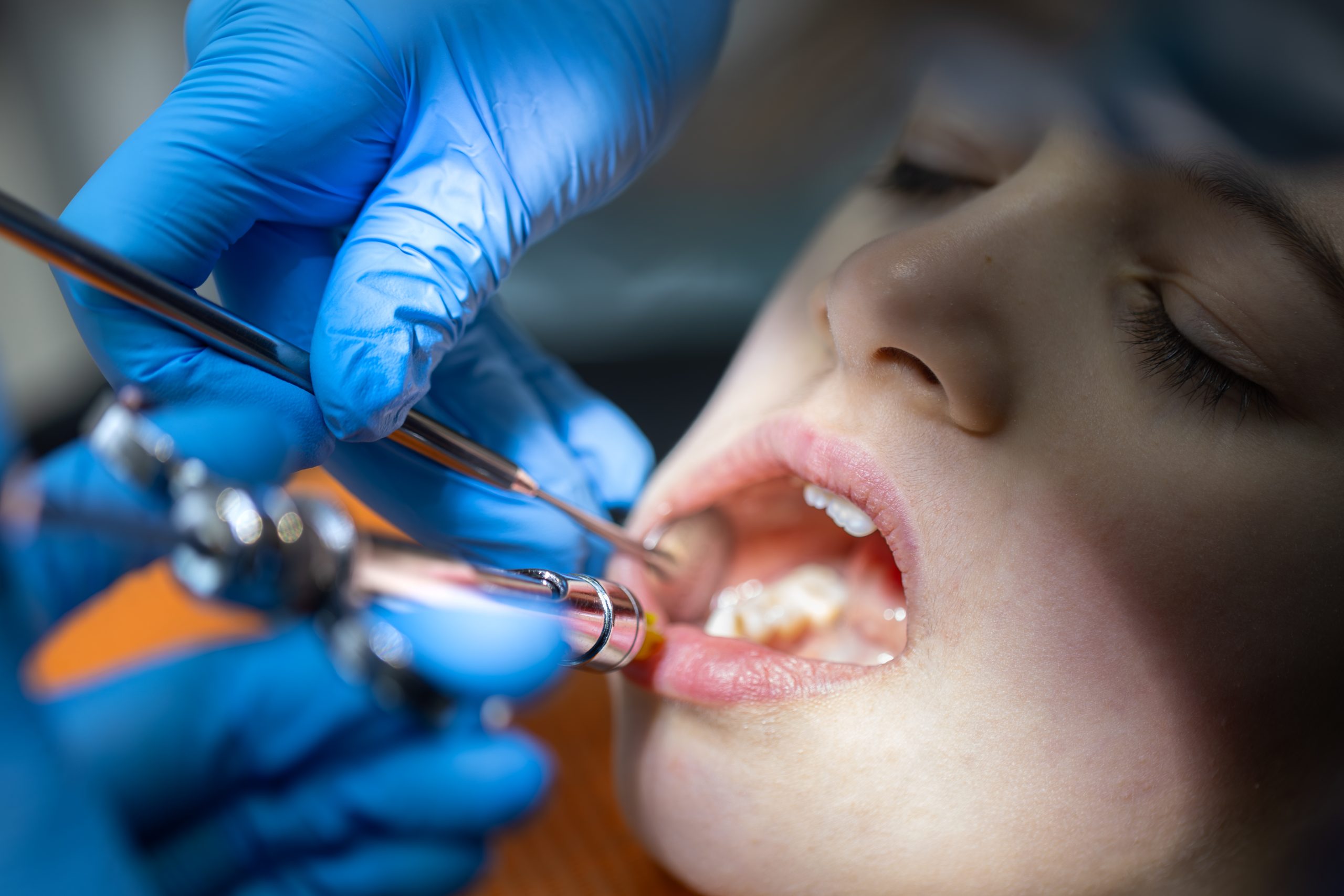 Tooth Decay and Cavity Treatment in Turramurra